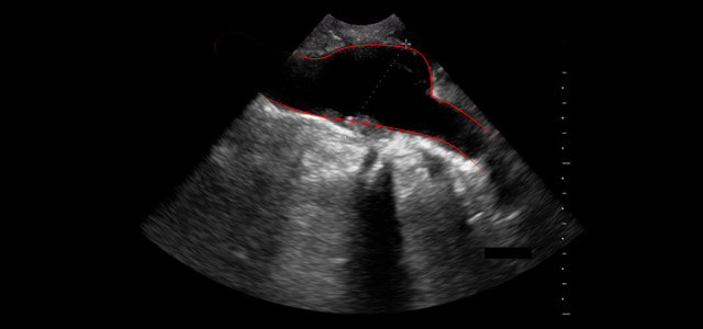 ultrasound-aaa